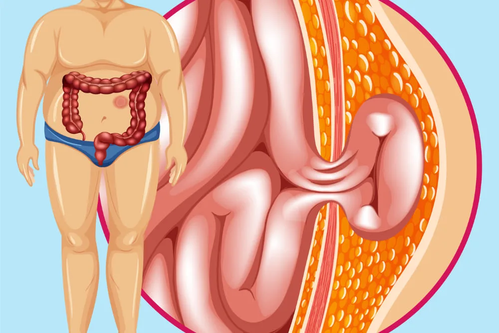 Cirugía de hernias (inguinal, umbilical y de pared abdominal) en CDMX: reparación segura y efectiva