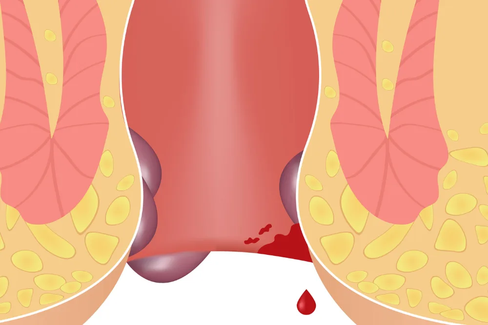 Manejo de fisura anal