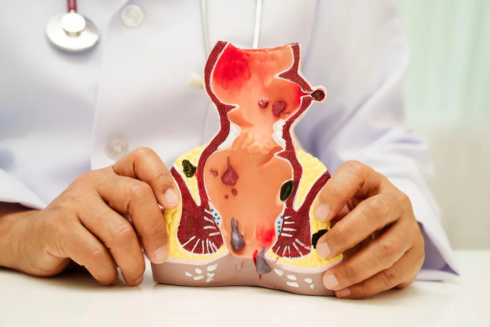 Tratamiento integral de la enfermedad hemorroidal